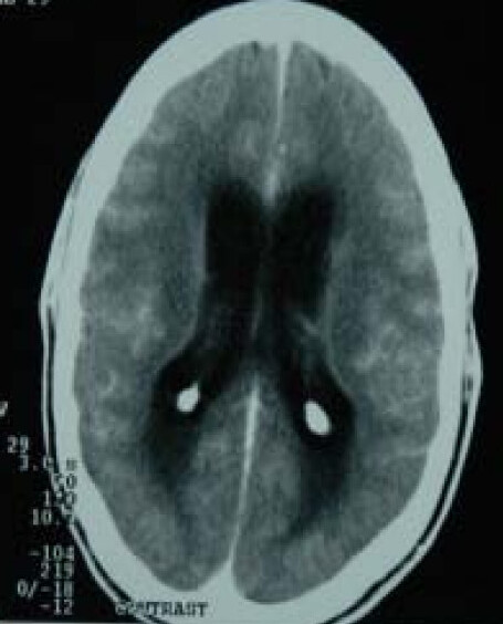 tuberculous meningitis